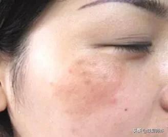 产后腹直肌分离恢复瘦肚子训练,产后腹直肌分离恢复的最佳方法