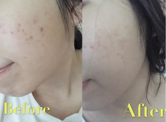 科普|光子嫩肤全攻略,做了光子后禁忌事项有哪些?