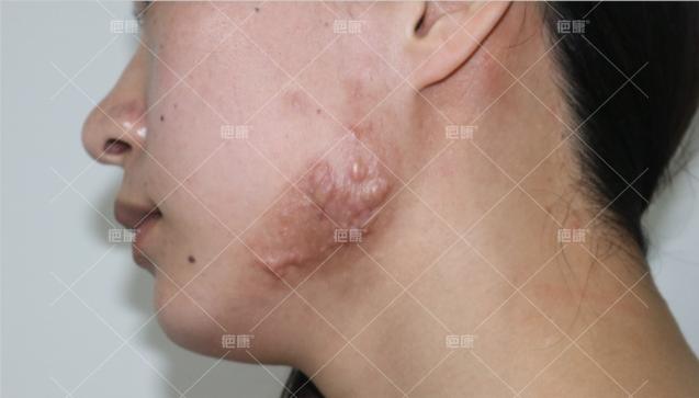 北京疤康对疤痕疙瘩能看好吗,疤康疤痕疙瘩恢复图片