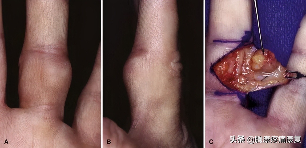 引起手部疼痛之购物袋综合征