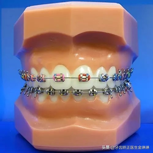 门牙不齐牙齿矫正一般多少钱,保定门牙有缝矫正需要多少钱