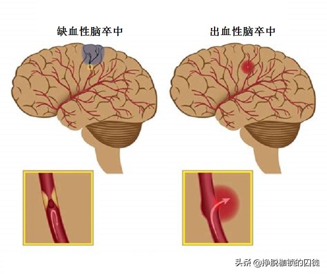 老人预防脑梗锻炼方法,老人预防脑梗每日吃多少叶酸片