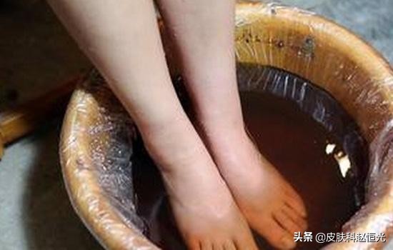 怎么预防脚上的灰指甲传染手上,灰指甲传染率高及时处理避免扩散