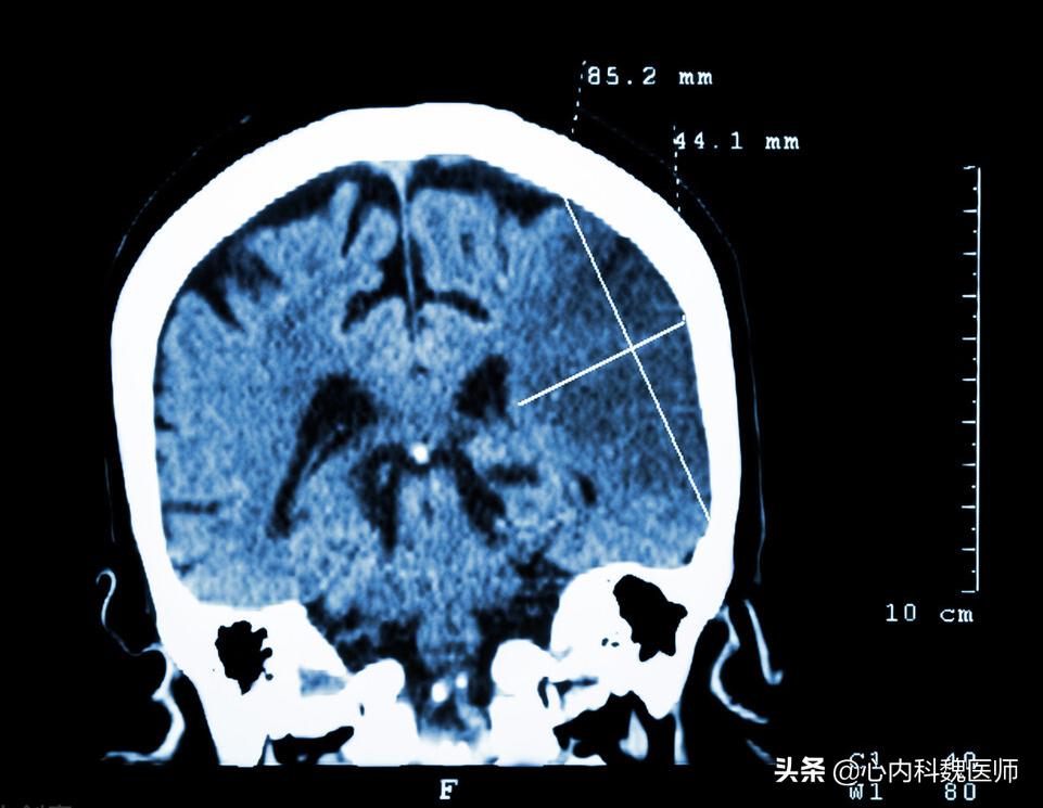 为何中国脑梗越来越多？医生：除了补充叶酸，做好这三点更重要