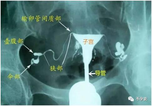 输卵管造影和输卵管通液区别,输卵管造影就是输卵管通液吗