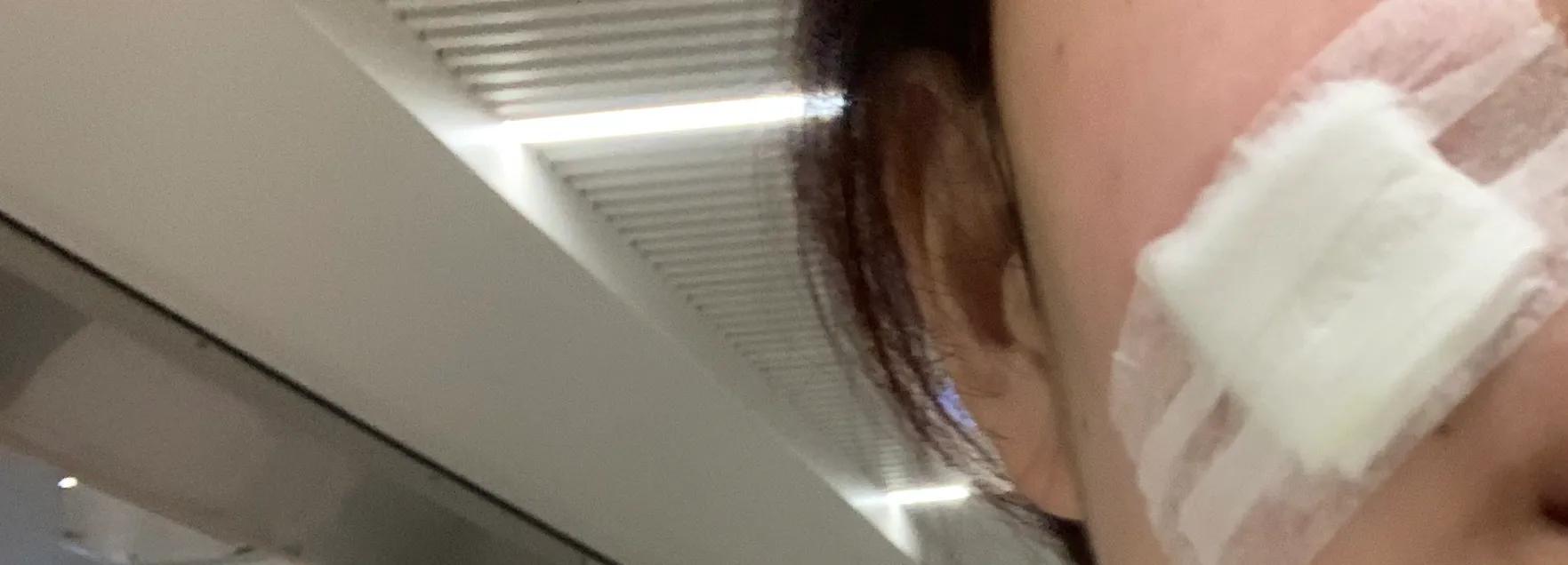 耳朵切痣恢复图片,切痣手术后恢复过程图