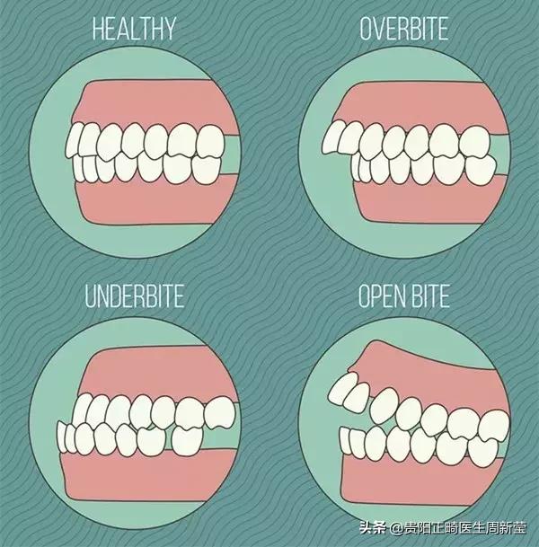 什么是“地包天”，地包天又该如何预防呢？