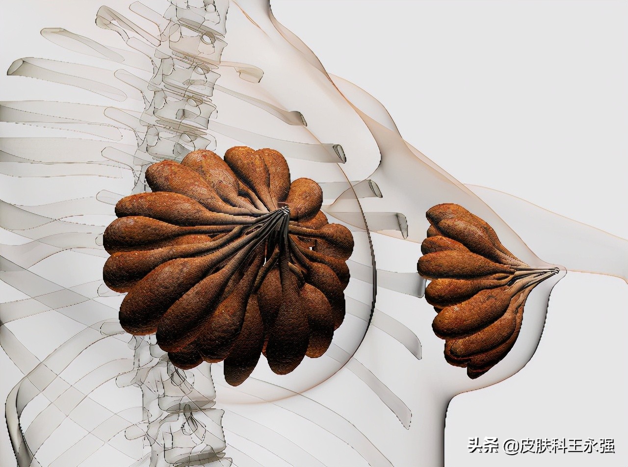 乳腺癌术后又发现肺结节，是转移还是原发肺癌？