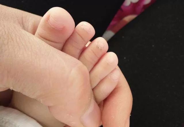 双脚干裂起硬皮怎么办,双脚干燥起皮