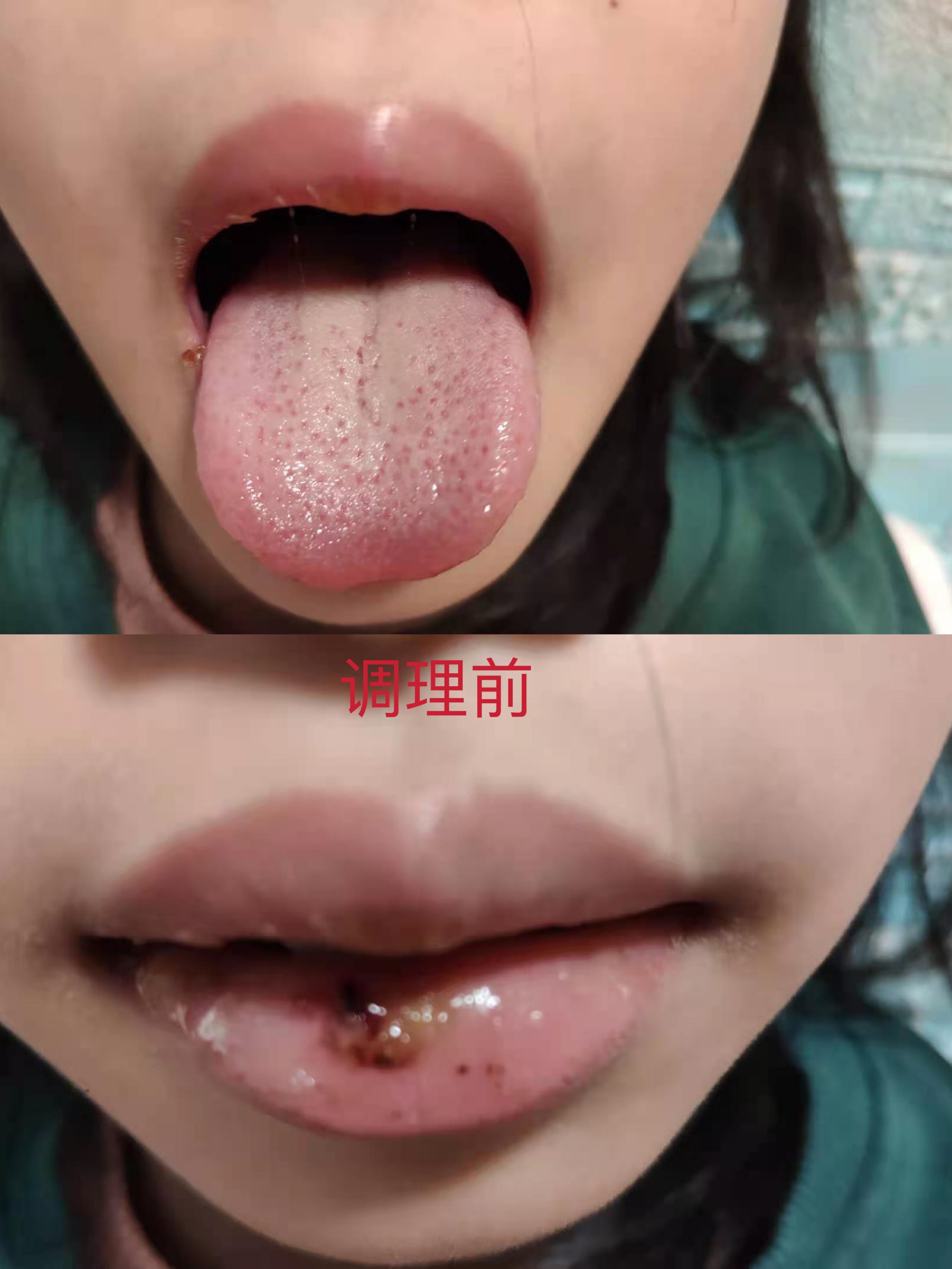陈久积食发烧中医处理方法,中医积食内热咳嗽推拿手法