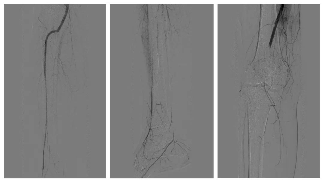 静脉血管堵怎么治疗,小隐静脉血栓处理