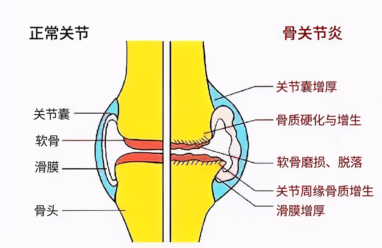 专治骨关节炎的中医,专业调理关节炎