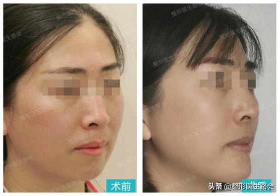 想要垫下巴│材料怎么选？手术疼不疼，过程怎样？听她亲口跟你说