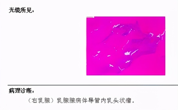 乳腺导管内乳头状瘤，该如何诊治？