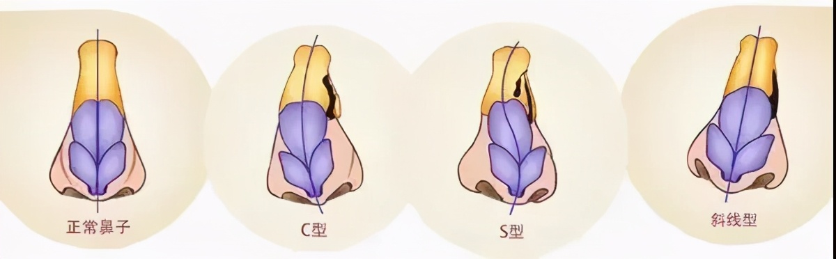 鼻中隔偏曲可引起鼻塞鼻出血,鼻中隔偏曲鼻出血用什么药