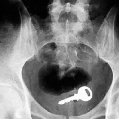 不作死就不会死,看看这些被人类搞进身体里的异物