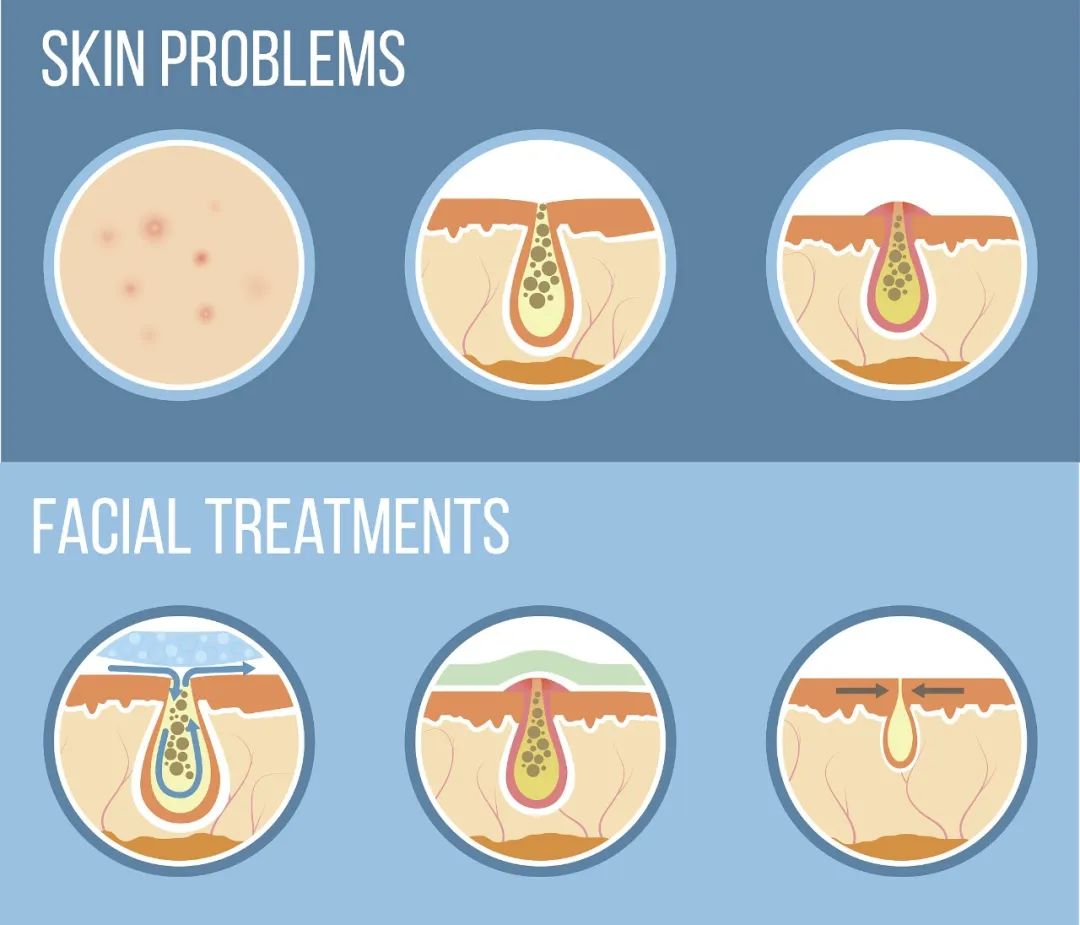 有的痘印为何一直无法消退,为什么痘印永远消不了