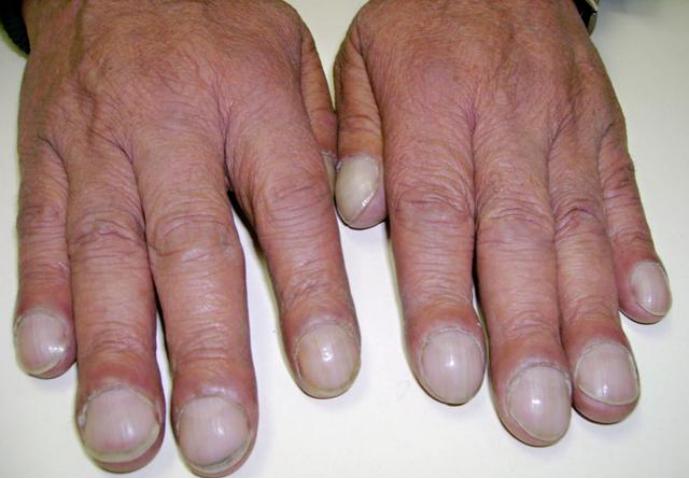 为什么吴邪可以治好肺病,吴邪肺纤维化最后结果