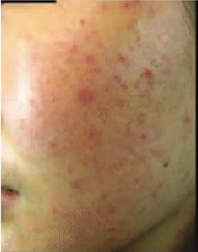 疱疹后遗症已三年了怎么办,痤疮后红斑怎么去除