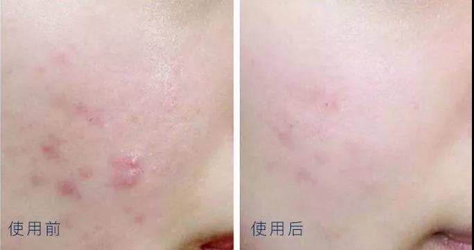 男士祛痘产品真实测评,祛痘坑修复凹洞产品测评