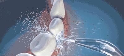 用冲牙器冲的牙很酸,用冲牙器后牙缝更大了