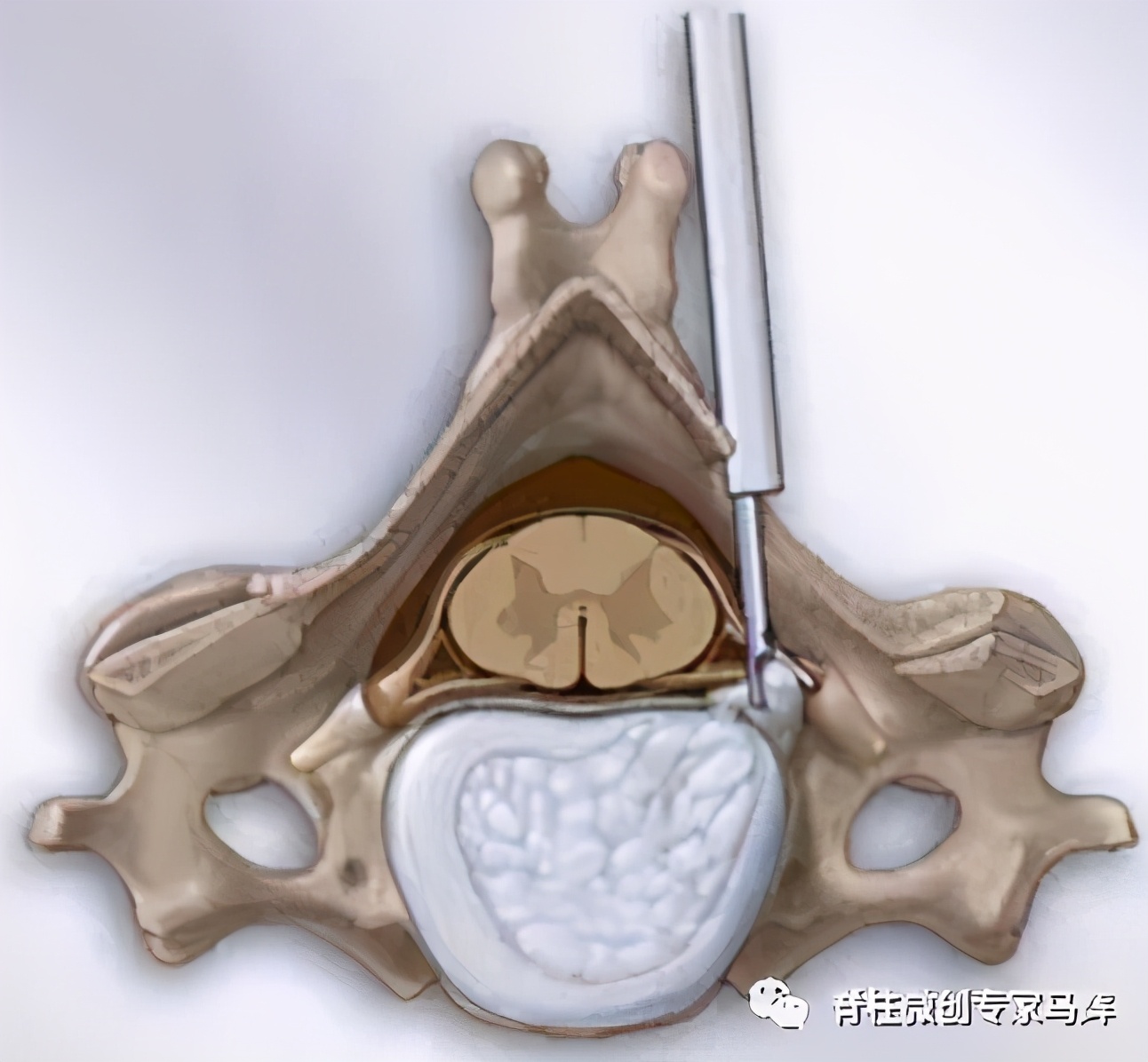 脊椎压迫神经做了微创术后腿麻疼,神经根损伤疼痛治疗