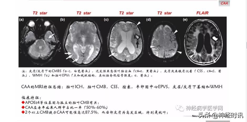 缺血性脑血管病出血评估,脑血管微出血怎么治疗