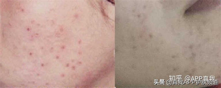 去痘印产品终极盘点，这几款效果肉眼可见！网友：价格效果成正比