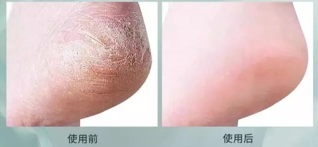 夏天了手脚干裂还有老茧,手脚干裂脱皮老茧用什么药膏