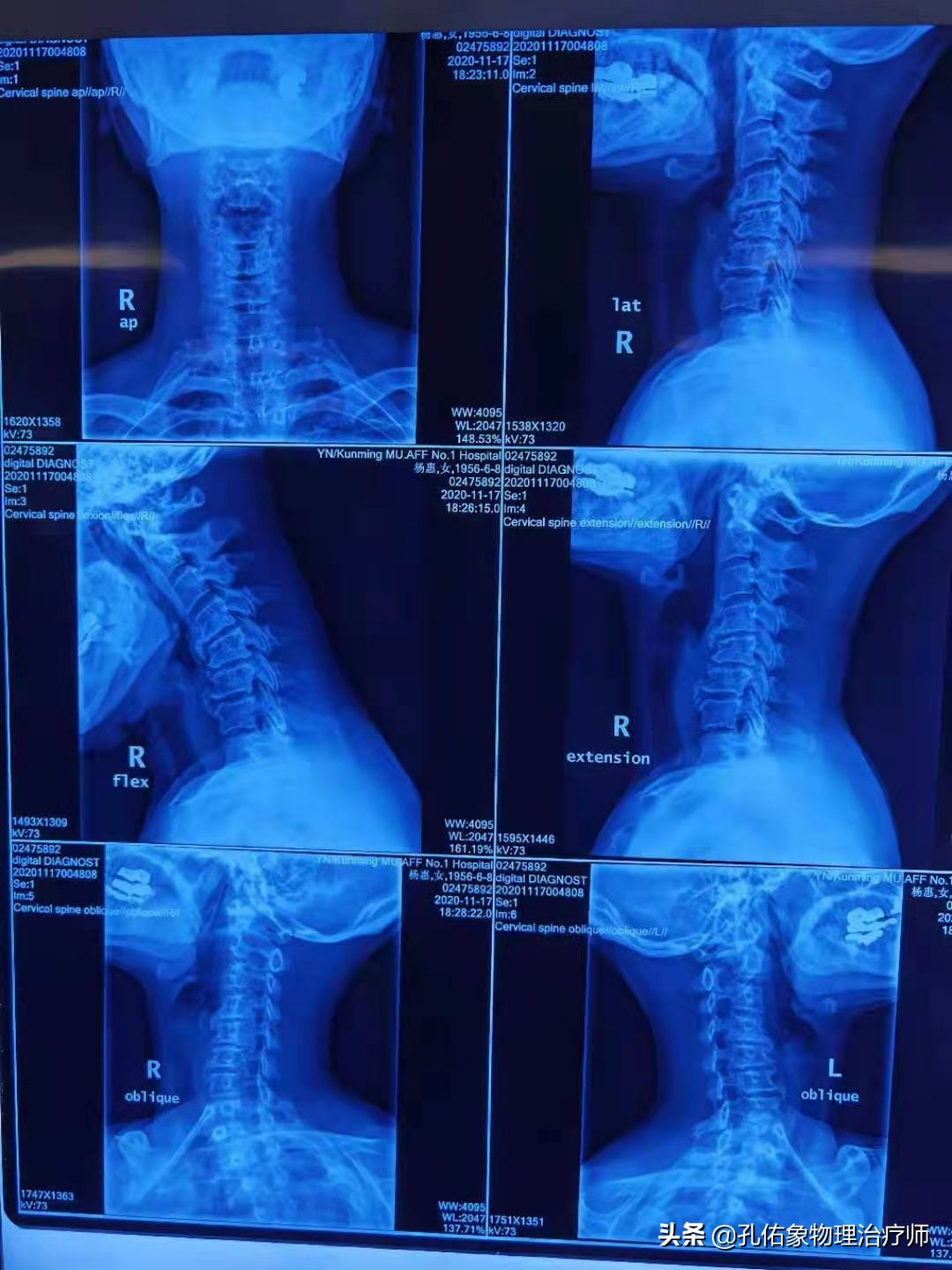 脖子按摩起来咯噔咯噔的怎么回事,转动脖子咔咔响什么原因