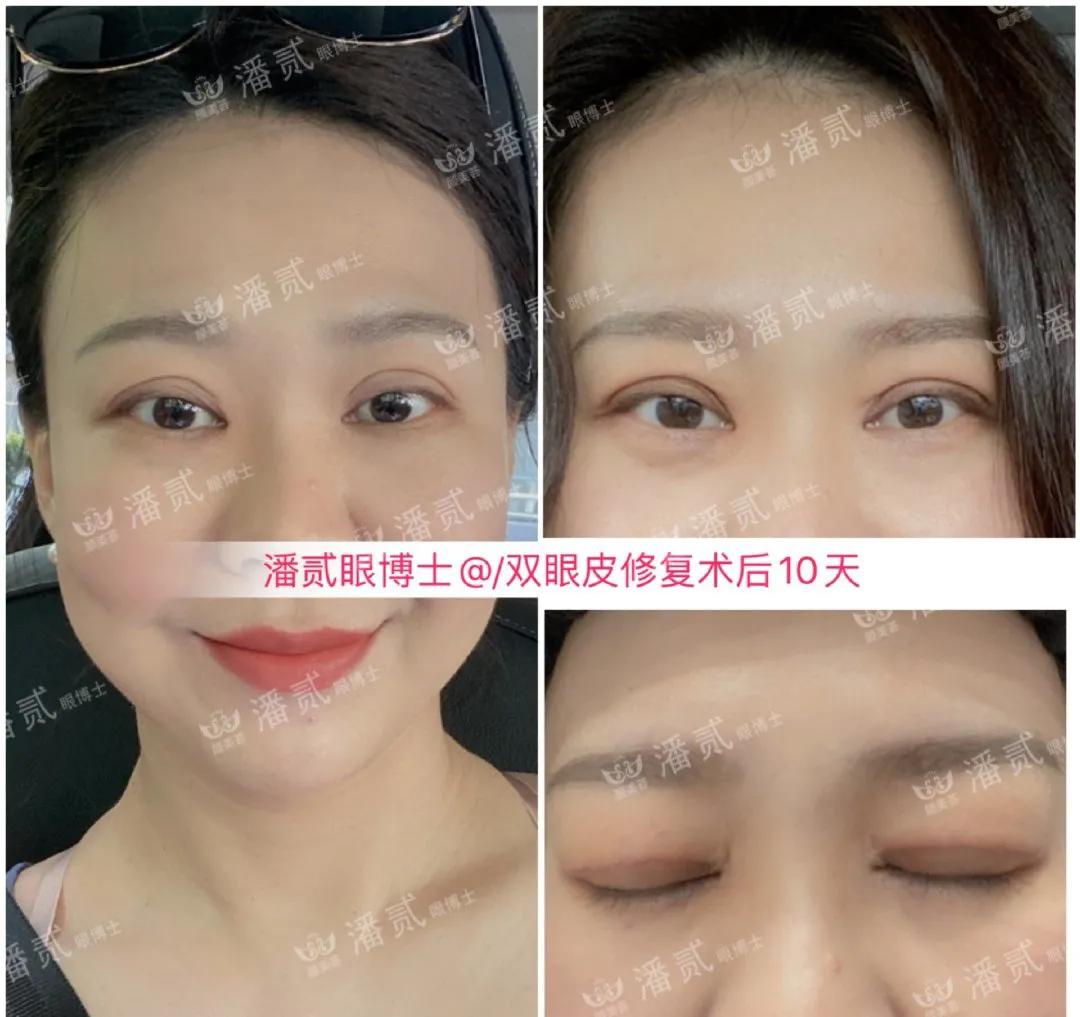 双眼皮修复改扇形双眼皮,平行双眼皮能改成开扇形双眼皮吗