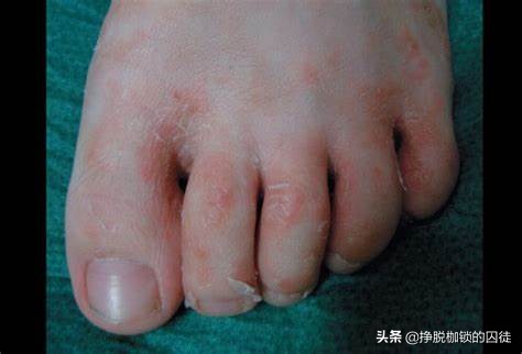 手每年春天手掌脱皮是什么原因,每年初夏手就开始脱皮