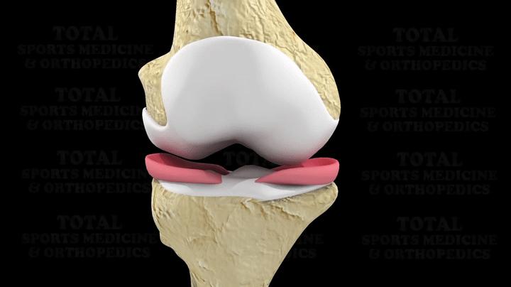 半月板损伤对足球运动员有多严重,足球运动员有半月板问题吗