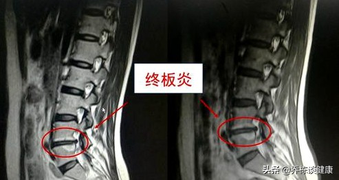 腰椎间盘退变损伤是怎么回事,腰椎间盘退行变是怎么回事