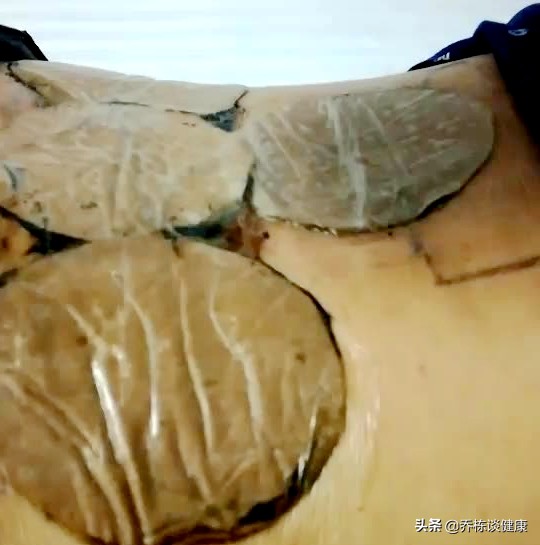 腰痛为啥贴消炎止痛膏药皮肤过敏,经常腰痛肩膀痛贴什么膏药