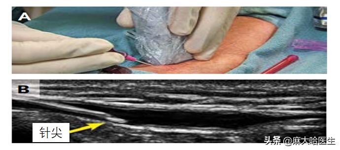 静脉扎针不回血是怎么回事,静脉针不好扎怎么办