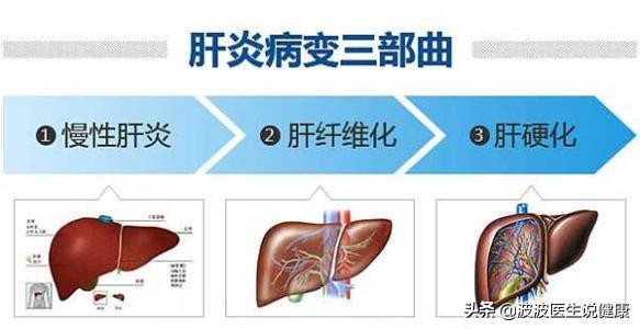 肝硬化肝癌诊治病例分享,2023年肝病防治指南