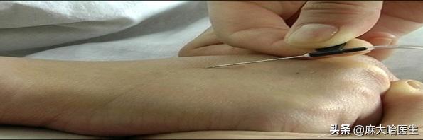 静脉扎针不回血是怎么回事,静脉针不好扎怎么办