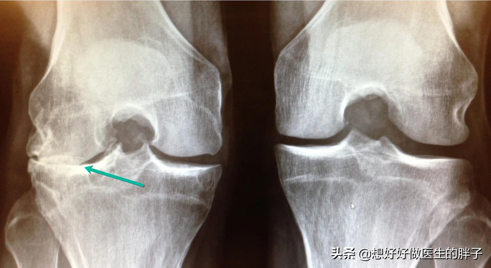 手指骨关节炎如何做康复锻炼,肩骨关节炎的康复锻炼