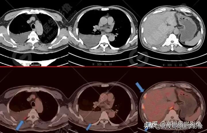 10毫米的肺结节恶性死亡率有多大,1厘米多的肺结节良性可能性多大