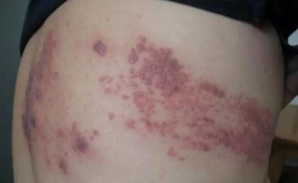 疱疹皮肤病疼痛怎么办,最痛的皮肤病有哪些种类