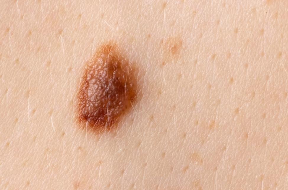 所有不规则的黑痣都是黑色素瘤吗,年轻生命的陨落