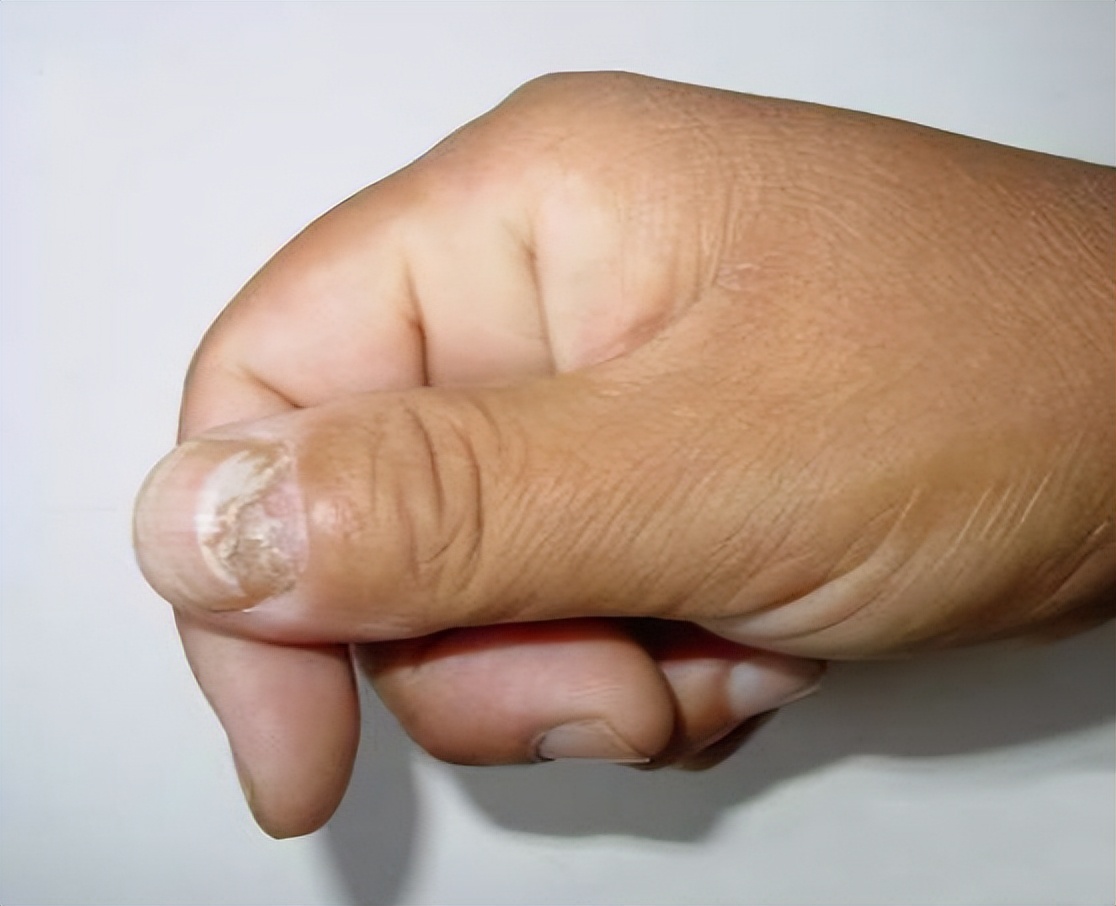 真菌性皮肤病—甲真菌病(灰指甲)