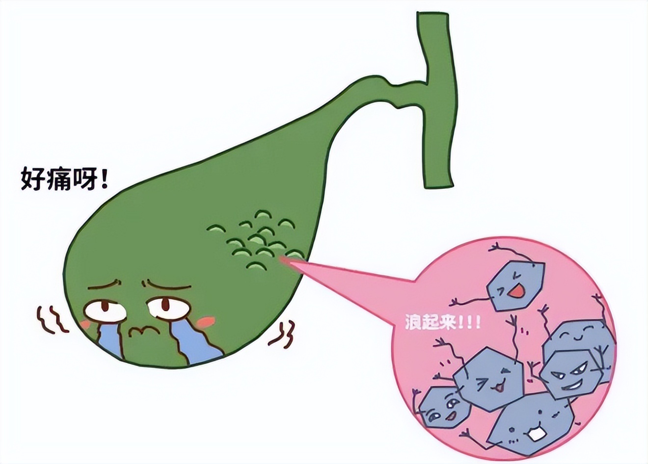 胆结石的四大误区,胆结石只有一个最佳治疗方法