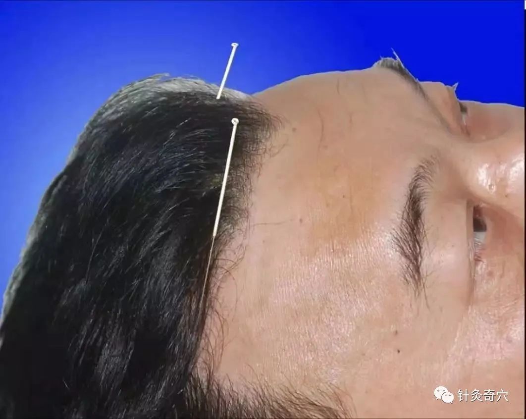 史上最全中医针灸视频教程全集,针灸治疗真实图片大全