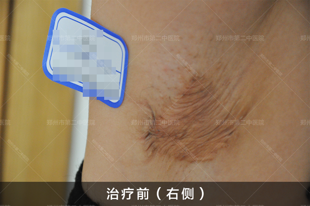 郑州腋下祛疤痕,郑州市第二中医院祛疤靠谱吗