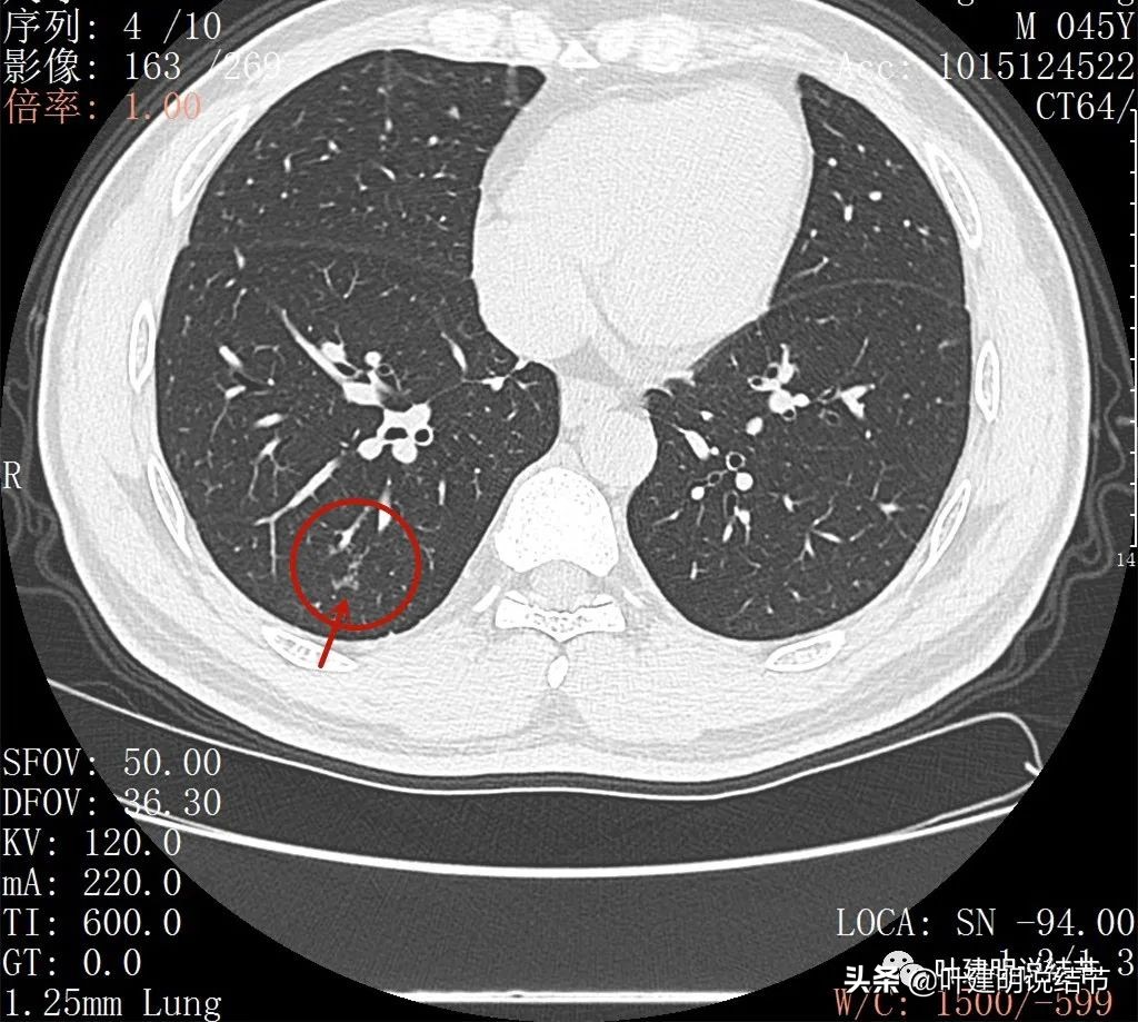 肺蜂窝状改变是肺癌吗,肺部陈旧灶与肿瘤怎么确诊