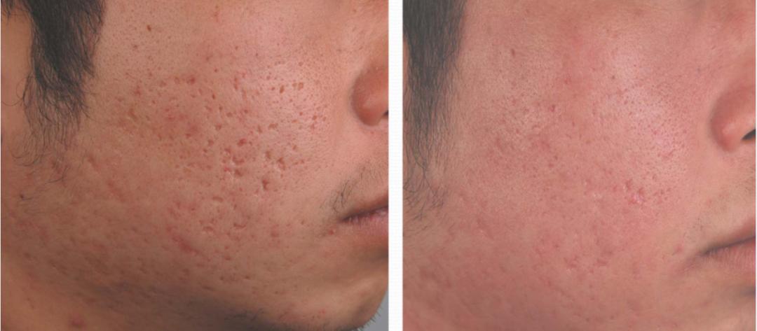 青春痘逆袭的方法,16岁青春期学生痘印如何改善