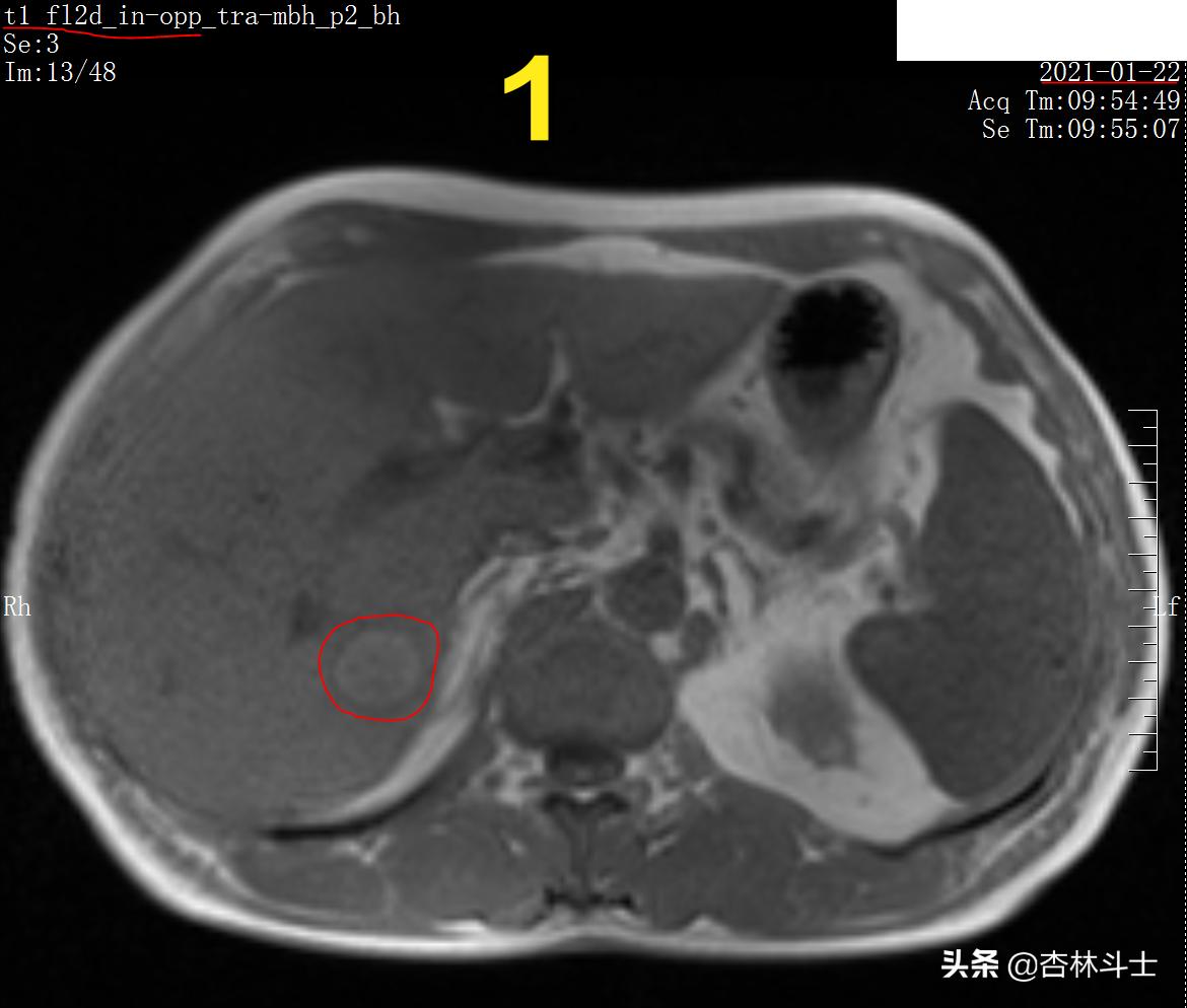 肝癌8公分肿瘤能活多久,肝癌细胞最大长多大