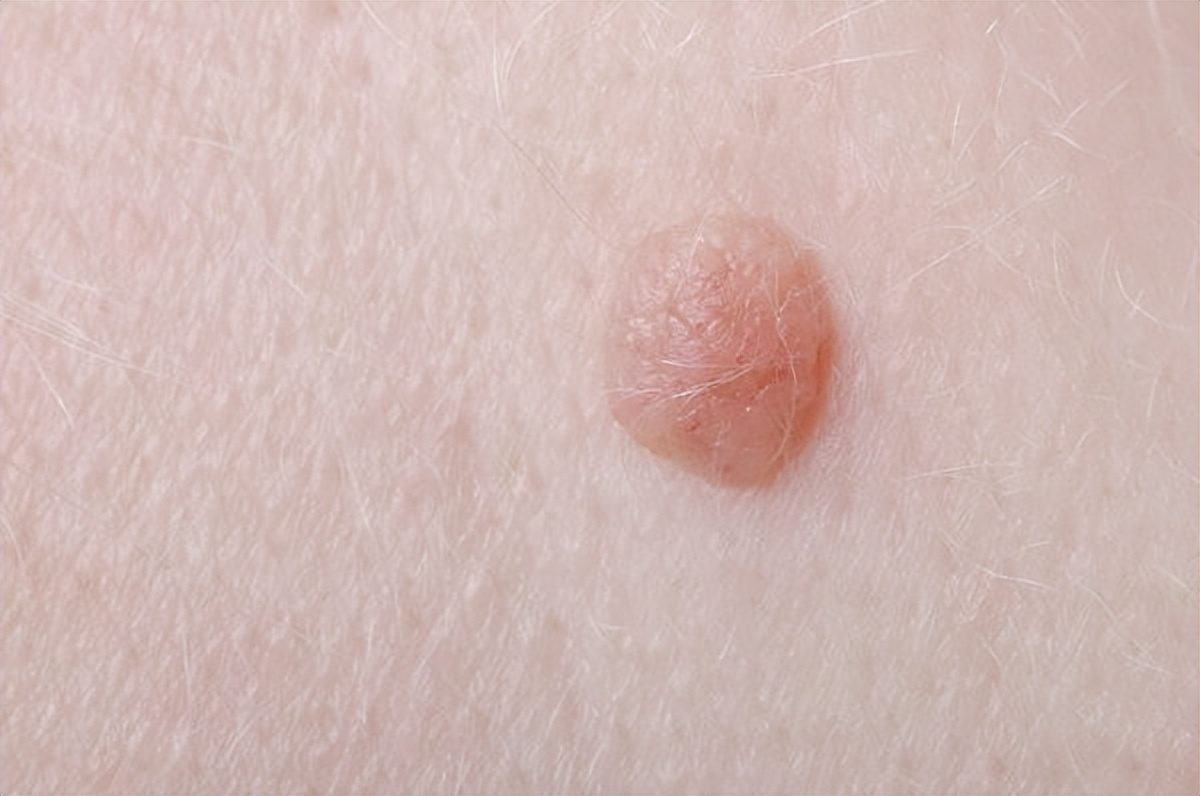 感染尖锐性湿疣都会有什么症状,女性尖锐湿疣症状